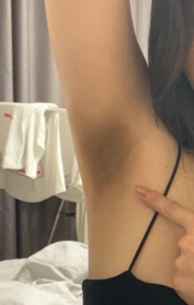 겨드랑이 관리 후 사진 1